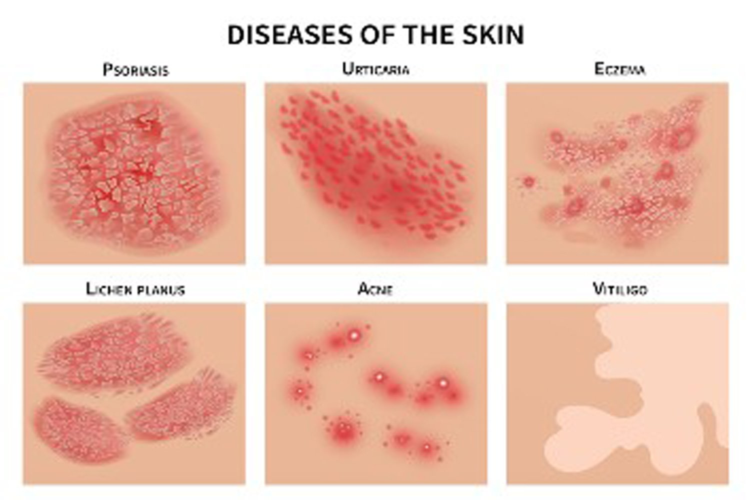 Skin Disease